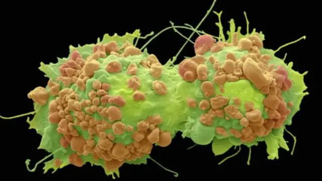 خلايا سرطانية