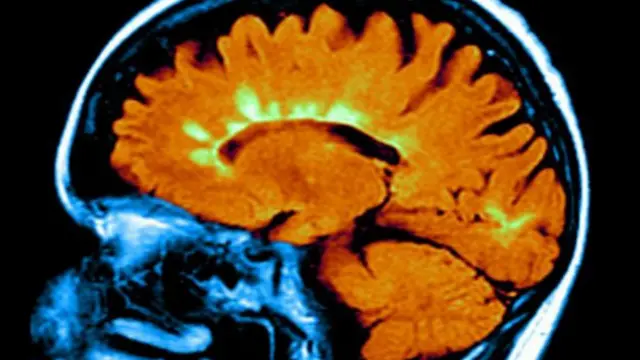 Bu beyin tomografisi MS hastalığının beyinde yol açtığı hasarı (fosfor yeşili bölgeler) gösteriyor
