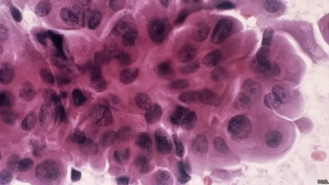 خون کا تجزیہ زیادہ مہنگا نہیں ہے، تاہم رسولی کے ڈی این اے میں سرطانی آثار کا تجزیہ اب بھی خاصا مہنگا ہے