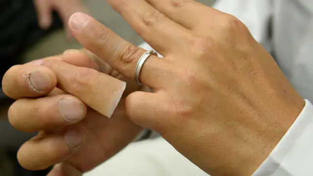 一名山口組成員為被截斷的拇指戴上義肢（資料圖片）