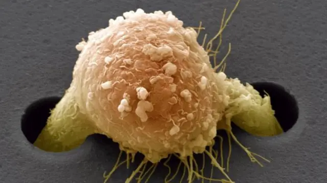 Elektron mikroskobu altında görülen metastaz yapmış göğüs kanseri hücresi.