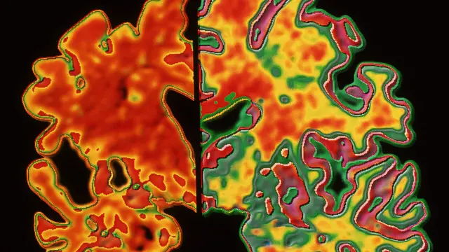 Sel kekebalan tubuh di otak bernama microglia disasar untuk mengurangi masalah ingatan.