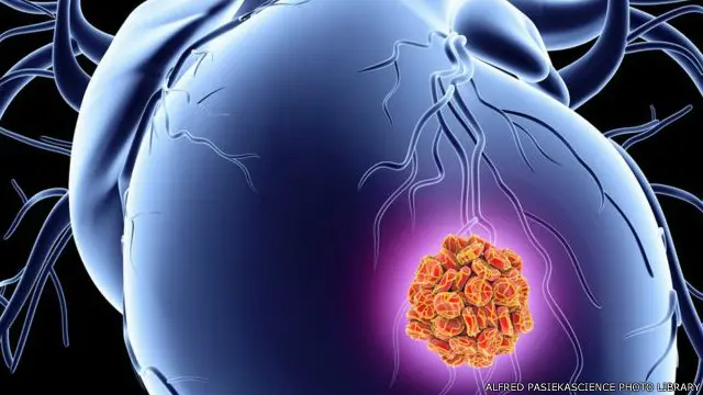 كشفت التجارب الأولية أن هذه اللصقة التي تفرز البروتين تساعد على نمو الخلايا السليمة في القلب 
