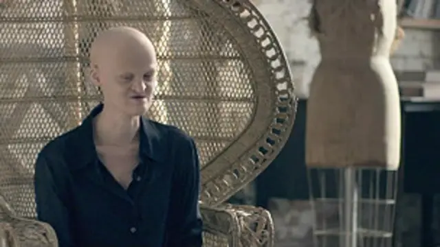 La modelo Melanie Goydos, que nació con una mutación genética llamada displasia ectodérmica, durante una entrevista con la BBC