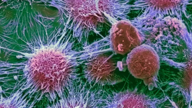 Раковые клетки в почке человека