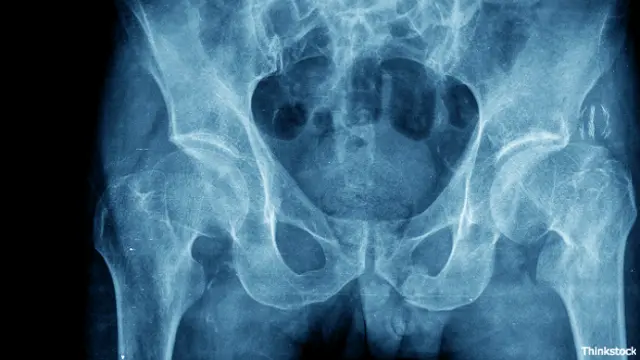 Place de huesos de la cadera