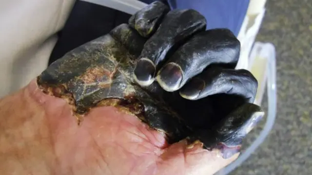 Mano con peste negra