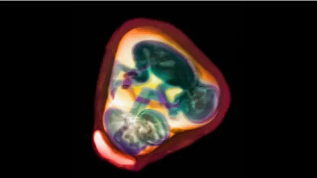 Gemelos idénticos en el útero