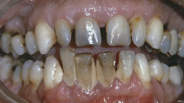 फ़ुटबॉलरों के दांत