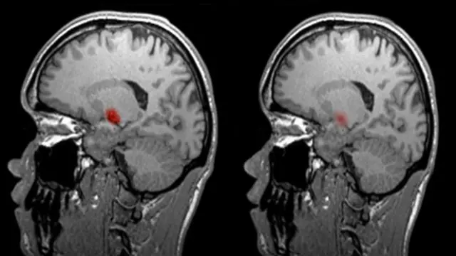 Yapılan işe göre beyinde hangi bölgenin aktif hale geldiği 'emar' yoluyla görülebiliyor. (SPL)