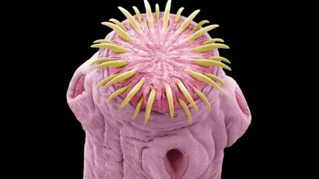 لوئی کے دماغ میں کیڑا ایک رسولی میں بڑا ہو رہا تھا 