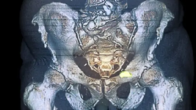 سرطان البروستاتا يمكن أن ينتشر إلى العظام (باللون الأخضر)