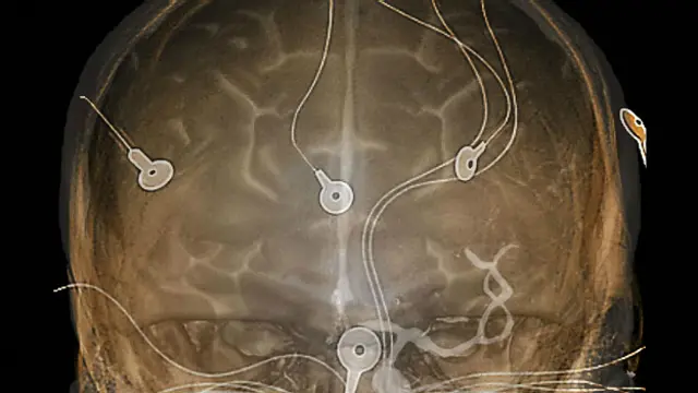 Сканирование мозга