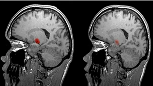 Испытуемых, помещенных в сканер фМРТ, просят их выполнять определенные мыслительные задачи, а исследователи при этом наблюдают за их мозговой активностью