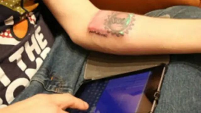 El implante anterior tenía el tamaño de una cajetilla de cigarrillos.