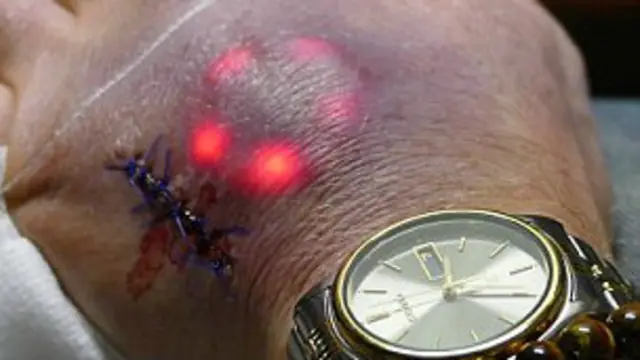 El implante tiene un grosor de 25 mm.