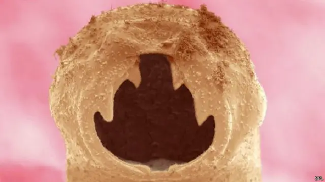 تسبب ديدان الانكلستوما تراجع في مستوى الخصوبة لدى النساء