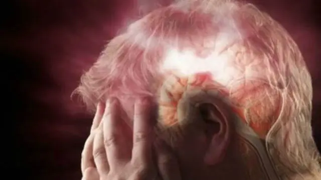 Estudo sugere que falar maisesportebet onlineuma língua pode 'proteger' cérebroesportebet onlinesequelas após derrame