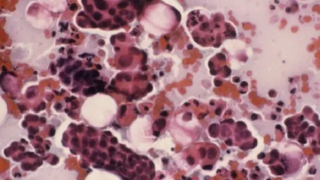 تطالب منظمات بإعطاء المصل المضاد للورم الحليمي للأولاد المراهقين