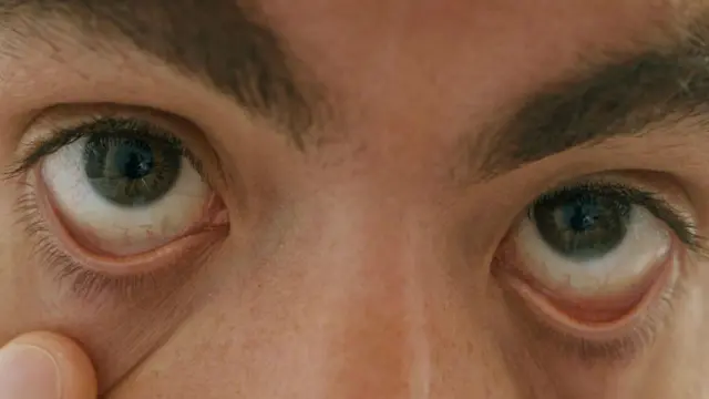 Глаза с похмелья