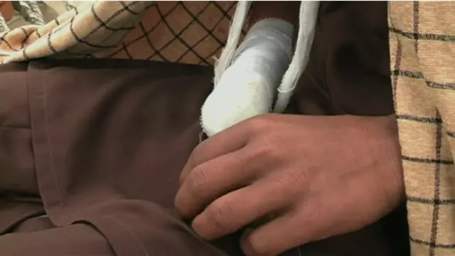 Mano amputada en Pakistán