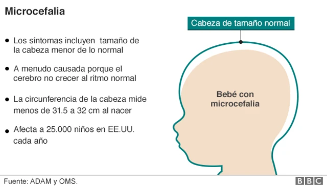 Gráfico sobre la microcefalia