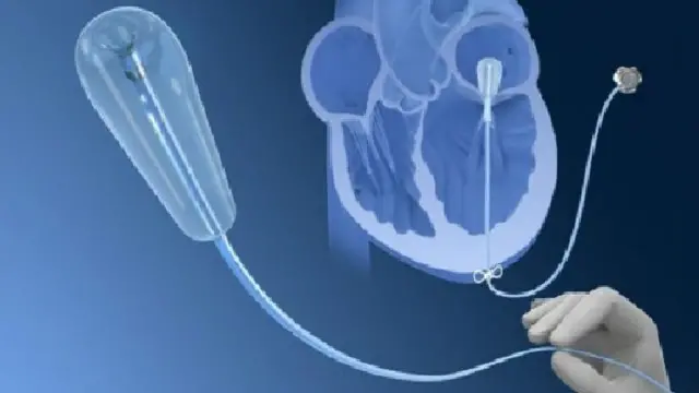 پروفیسر وینڈلر سمجھے ہیں کہ یہ طریقہ علاج دل کے مریضوں میں اوپن ہارٹ سرجری کا متبادل ثابت ہو سکتا ہے