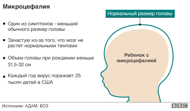 микроцефалия