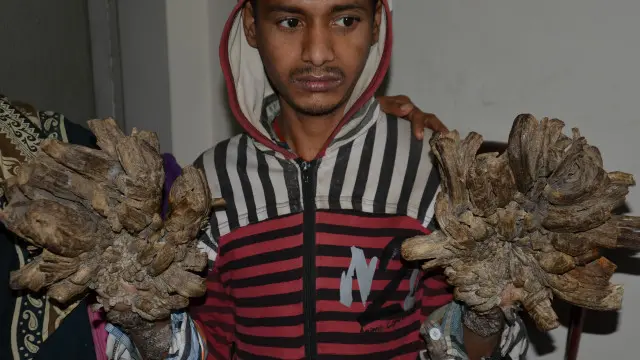 Dia mengaku sebagian tubuhnya mulai ditumbuhi kutil sekitar 10 tahun silam. "Awalnya, saya berpikir kutil-kutil itu tidak berbahaya," kata Bajandar.