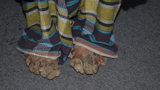 অসুখটি পায়েও ছড়িয়ে পড়ছে