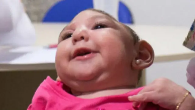 Se ha visto un aumento de los casos de microcefalia en Brasil, vinculados al zika.