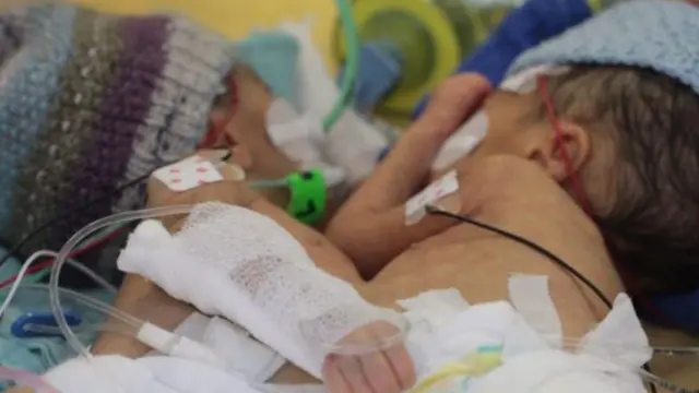 الفتاتان هنا في حالة التصاق قبل إجراء العملية وكان وزنهما معا 2.2 كيلوغرام