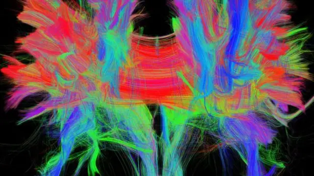 Beyindeki iki yarıküre arasındaki bağlantılar koparıldığında insanların duygusuzlaştığı ve duygularını ifade edemediği görülür.