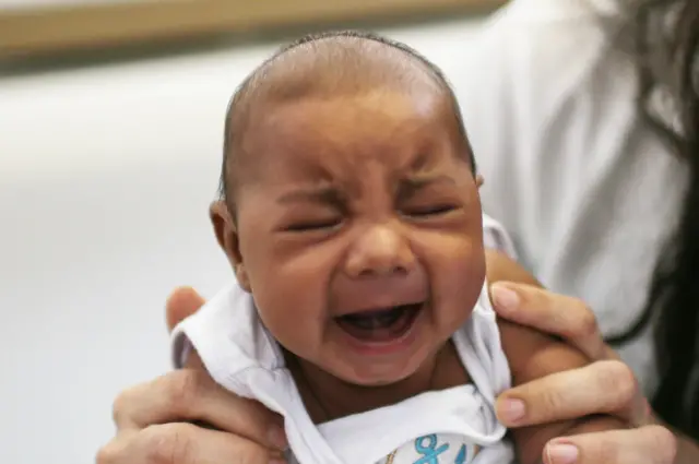 Bebé con microcefalia en Brasil