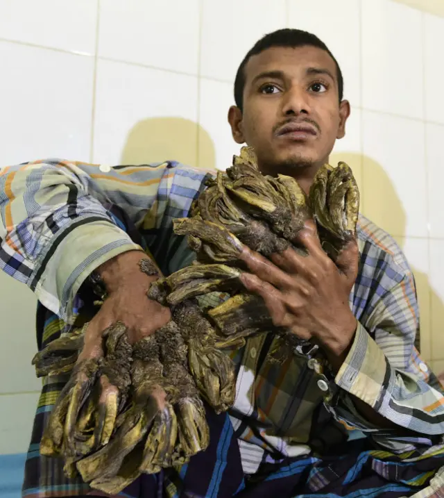 Abdul Bajandar, el "hombre-árbol" de Bangladesh