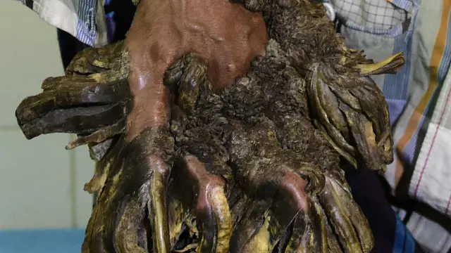 Abdul Bajandar, el "hombre-árbol" de Bangladesh
