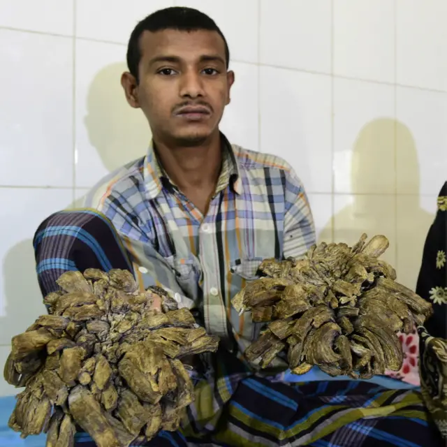 Abdul Bajandar, el "hombre-árbol" de Bangladesh