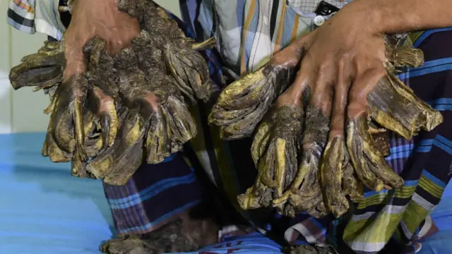Abdul Bajandar, el "hombre-árbol" de Bangladesh