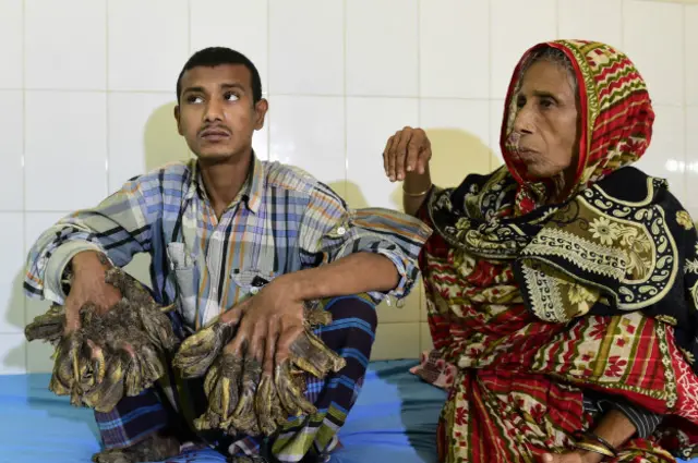 Abdul Bajandar, el "hombre-árbol" de Bangladesh