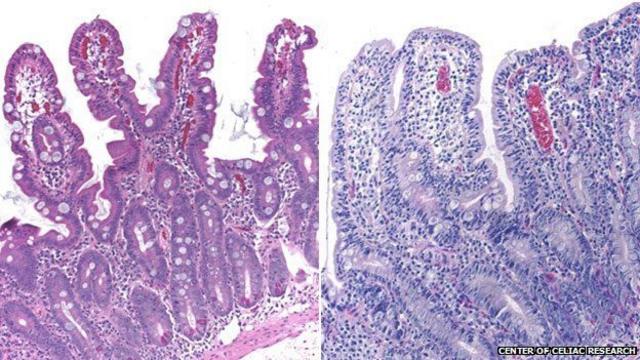 Comparação entre um intestino saudável (esq.) e umwww caixaeconomicafederal loteriasum paciente que sofrewww caixaeconomicafederal loteriasdoença celíaca