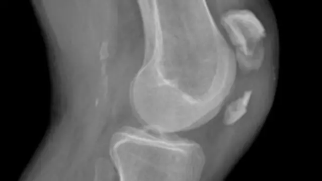 အရိုးကို ဖဲ့ယူပြီး လိုအပ်တဲ့ တခြား နေရာမှာ အစားထိုး ရတာ ဖြစ်ပါတယ်