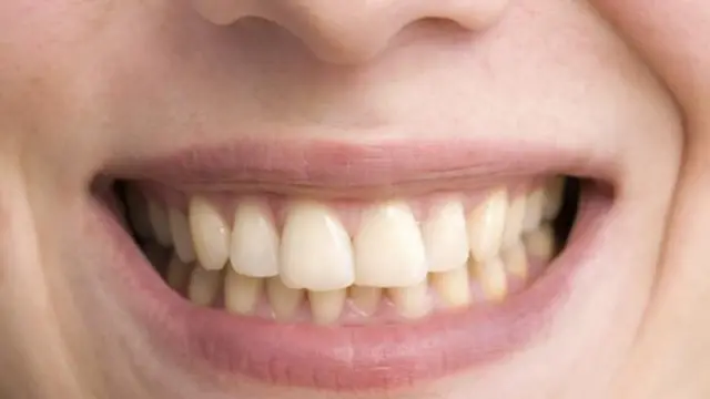 牙科医生表示,茶的天然染料比咖啡更容易附着在牙釉质上(图片来源:Getty Images)