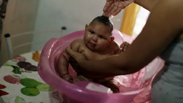 الباحثون يعتقدون بوجود علاقة بين فيروس زيكا وصغر حجم رؤوس الرضع حديثي الولادة