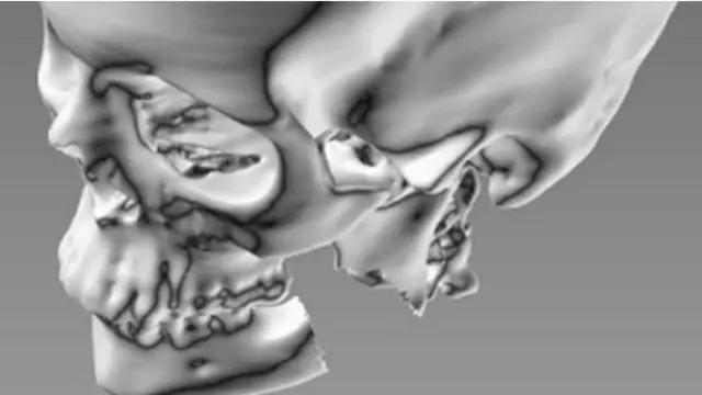 томография сломанной челюсти
