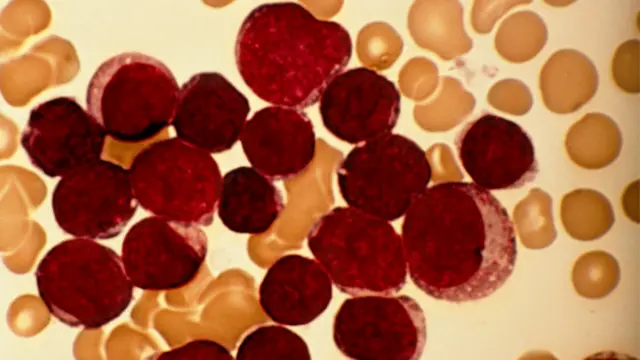 Острая лимфобластная лейкемия