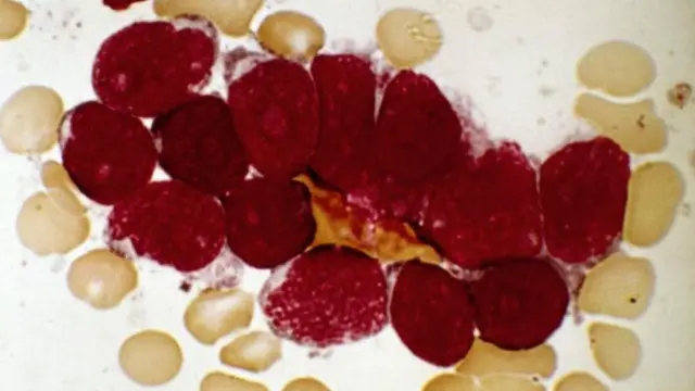 التجربة تقوم بإعادة تدريب الخلايا القاتلة على مهاجمة الأورام الخبيثة