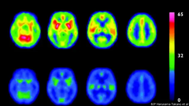 Estas imágenes de un tomógrafo muestran el flujo sanguíneo en el cerebro durante el "choque" y posteriormente. Un grupo de científicos liderado por el investigador Harumasa Takano publicó estos resultados en la Revista Británica de Psiquiatría, British Journal of Psychiatry, en 2006.