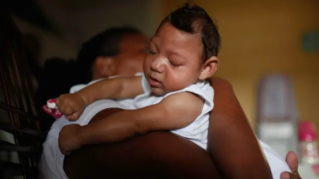 Penelitian CDC dari AS kini sudah membenarkan kaitan antara Zika dan microcephaly.