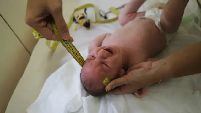 Virus Zika được xác định có liên quan đến chứng đầu nhỏ ở trẻ sơ sinh