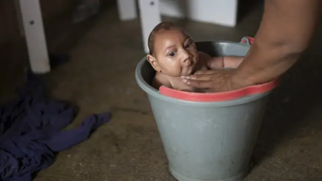 Младенец с микроцефалией